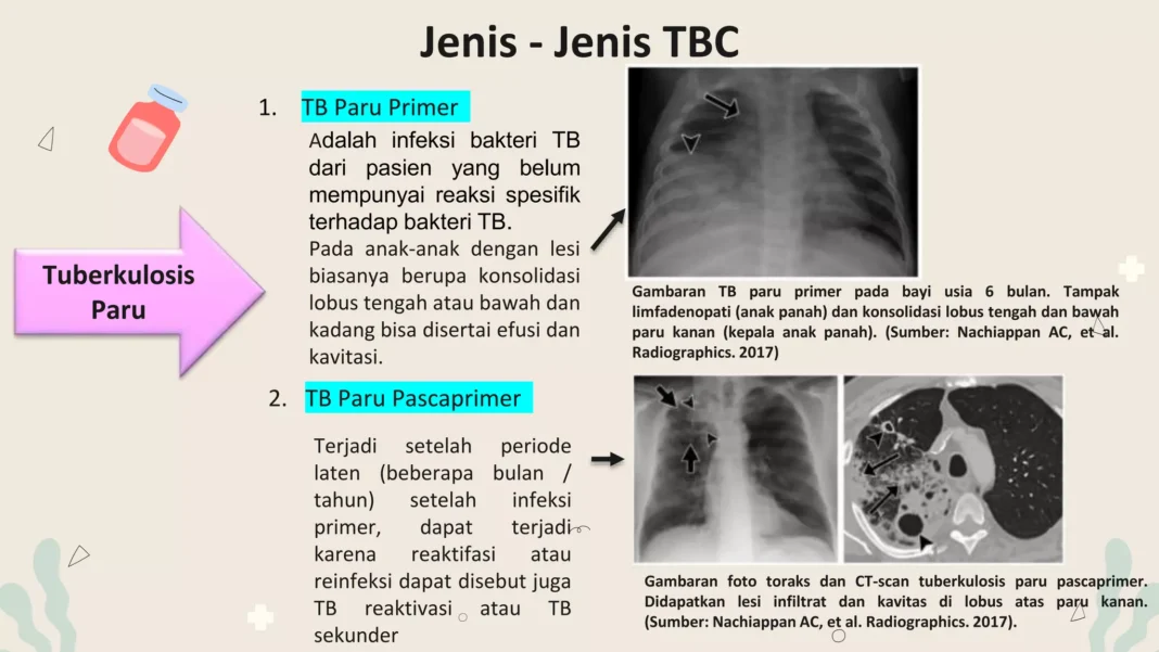 Curhat Wanita Jaksel Ngeluh Benjolan di Leher Dikira Seminggu Hilang, Tahunya TBC
